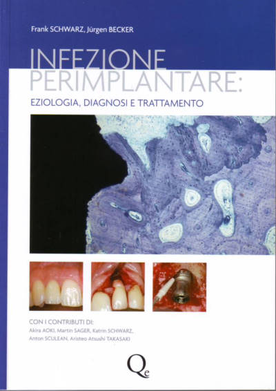 Infezione perimplantare: eziologia, diagnosi e trattamento